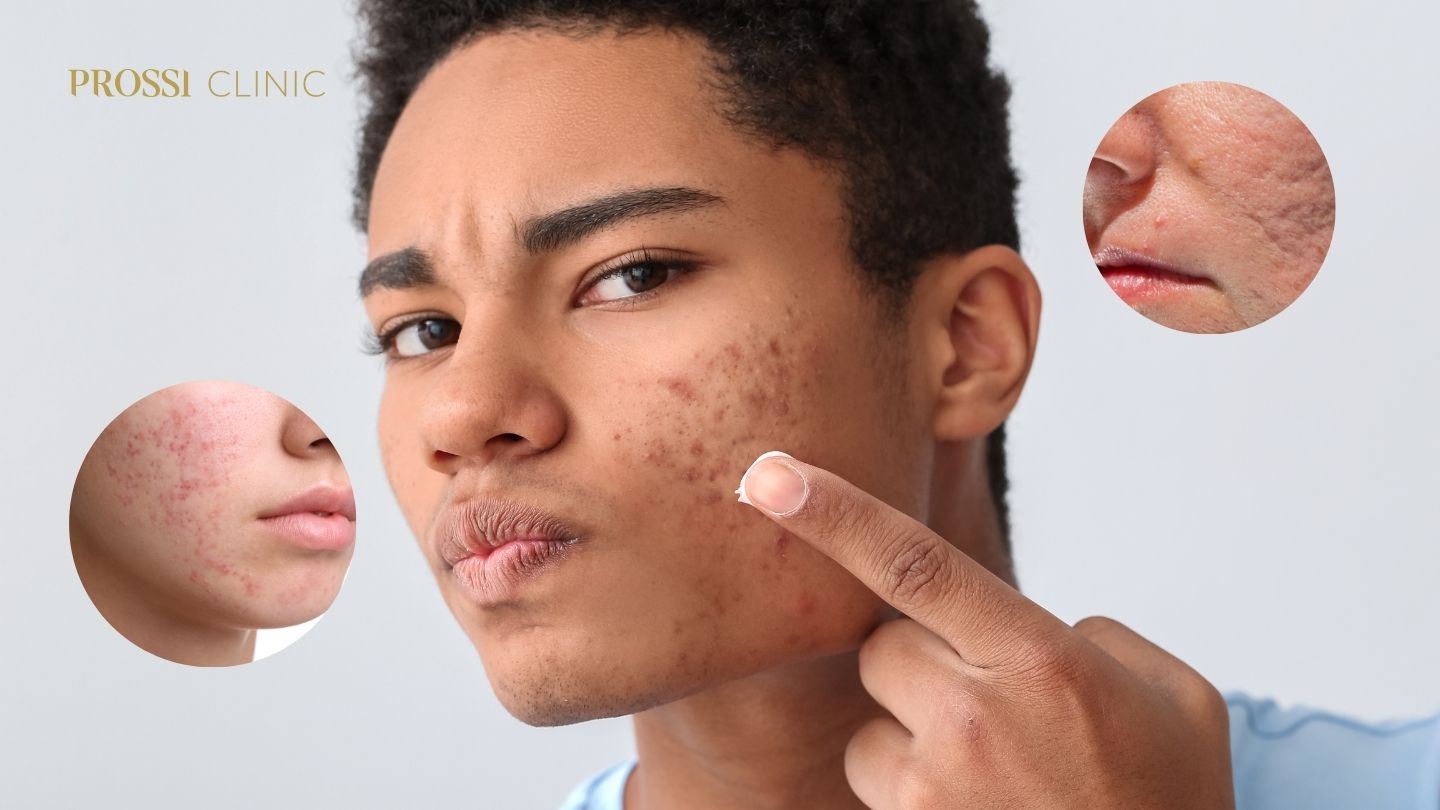 Scar Treatment: Pilihan Perawatan untuk Bekas Jerawat Membandel