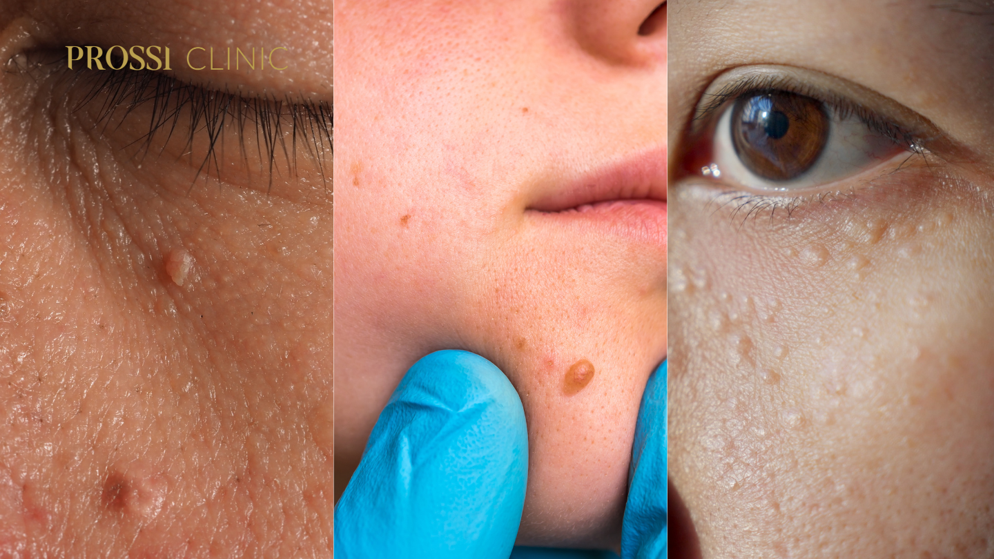 Penyebab dan Cara Menghilangkan Skin Tag, Kutil & Milia