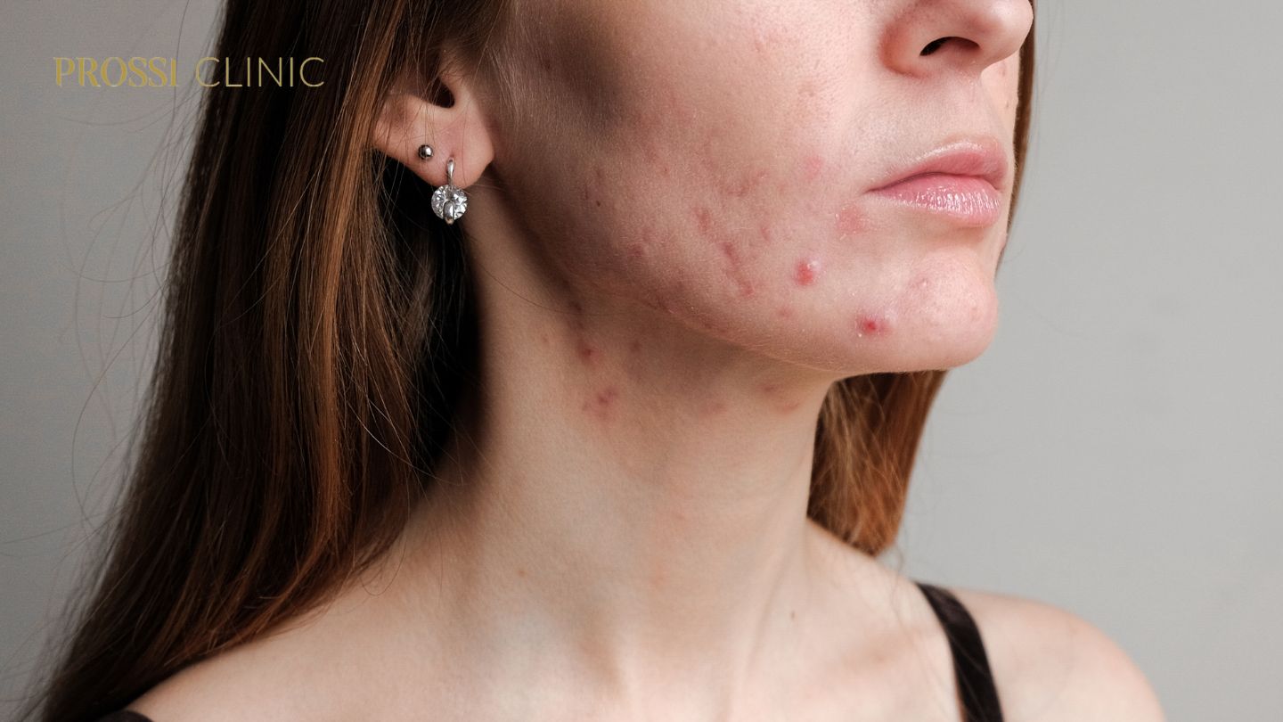 Atasi Jerawat dari Akar Masalahnya dengan Acne Program Bersama Dokter Spesialis Kulit Prossi Clinic