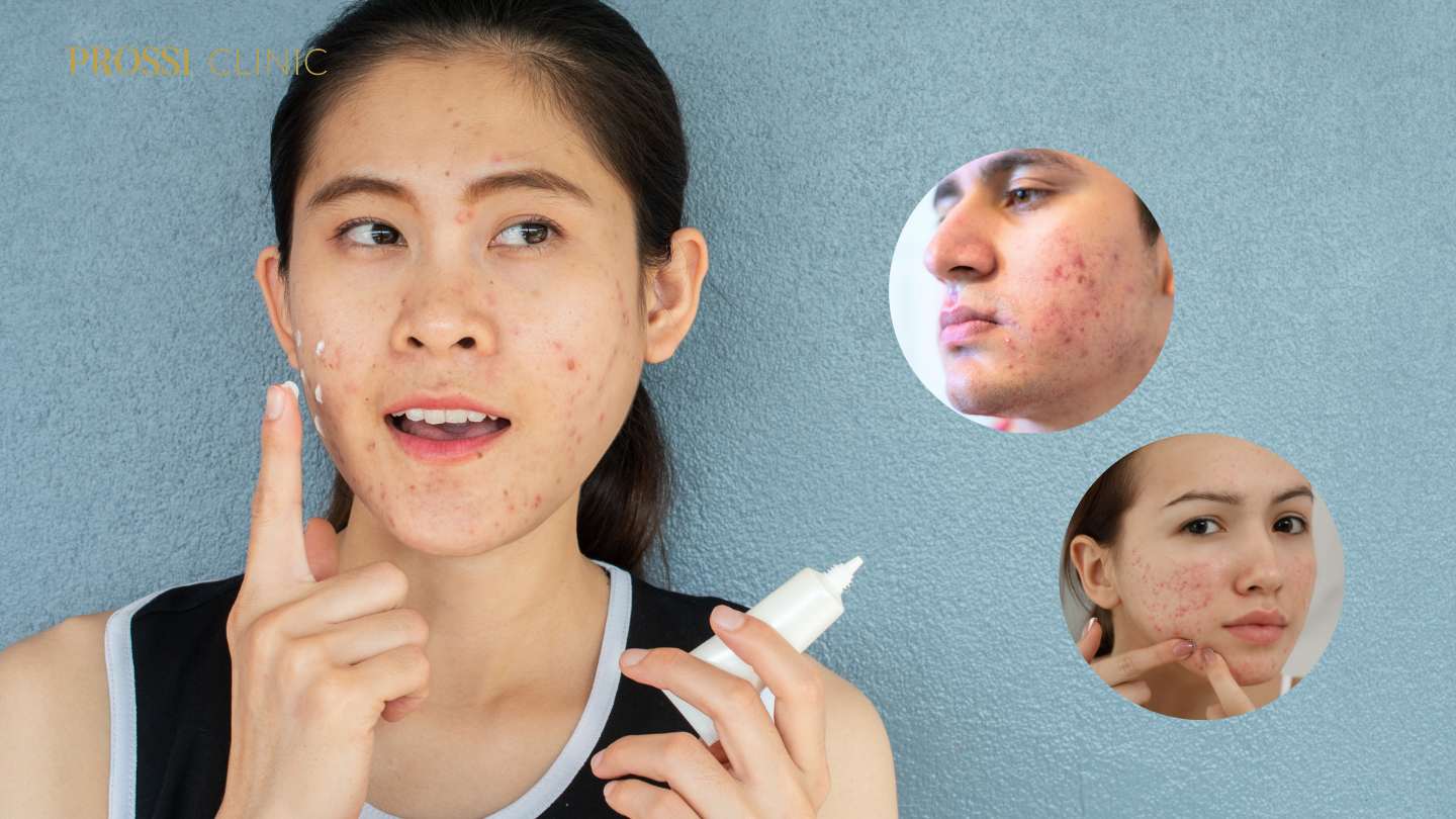 Kenapa Jerawat Kambuh Terus? Waspada Ketergantungan Krim