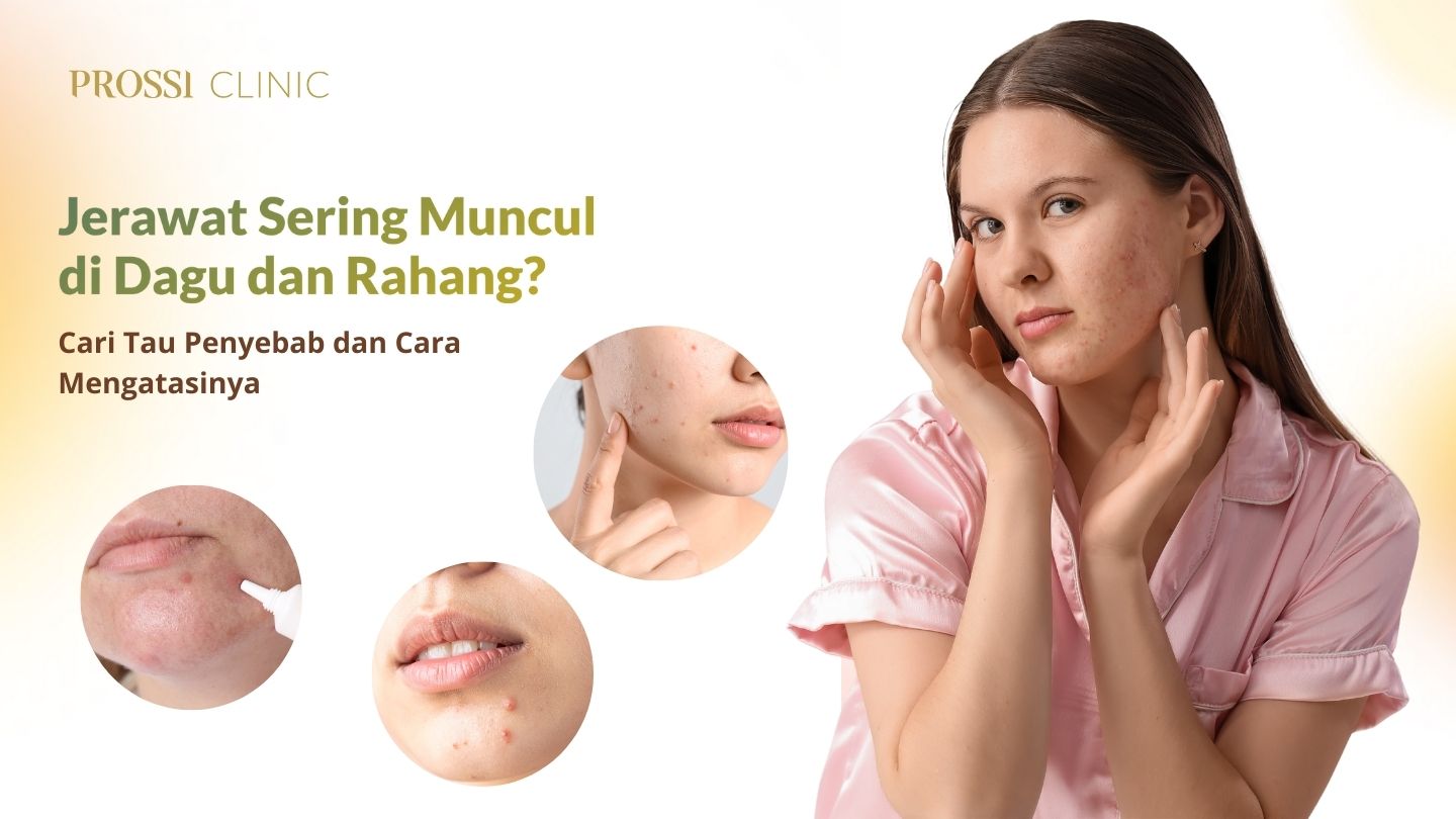 Jerawat Hormonal: Kenapa Sering Muncul di Dagu dan Rahang? Ini Penyebab & Cara Mengatasinya