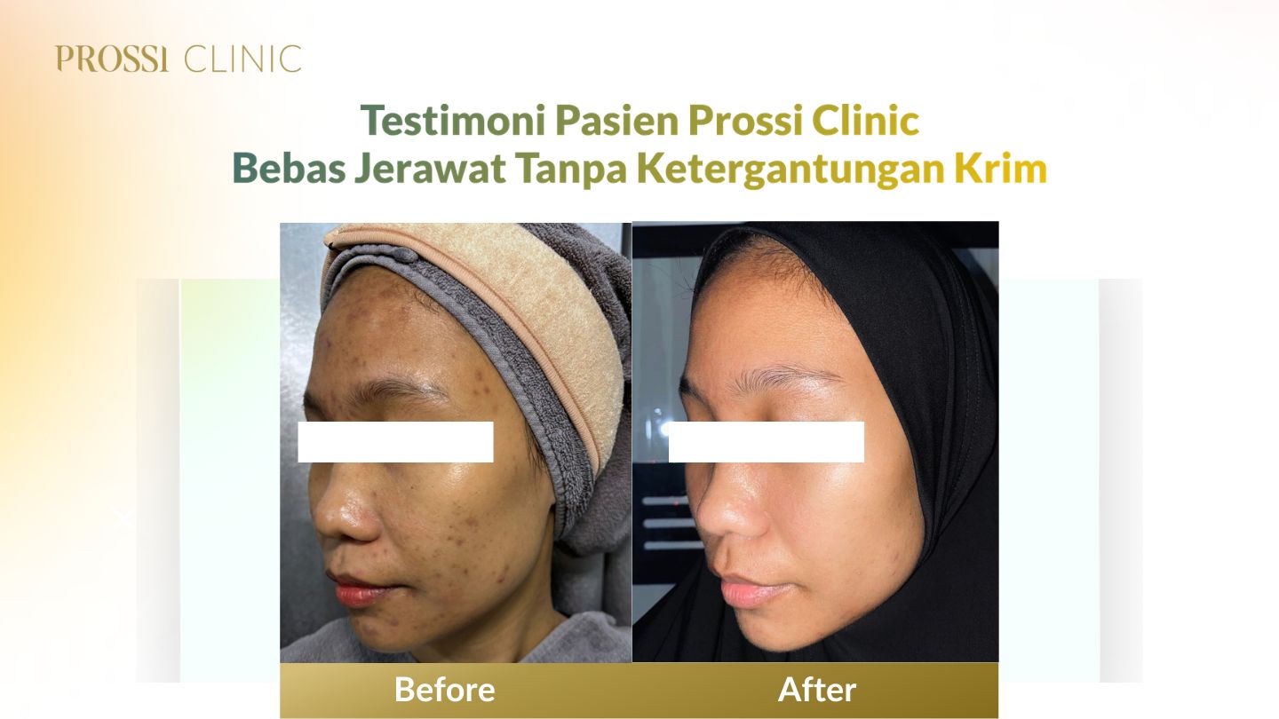 Jerawat Tak Kunjung Sembuh? Ini Cerita Nyata Pasien Prossi Clinic yang Akhirnya Bebas Jerawat Tanpa Ketergantungan Krim