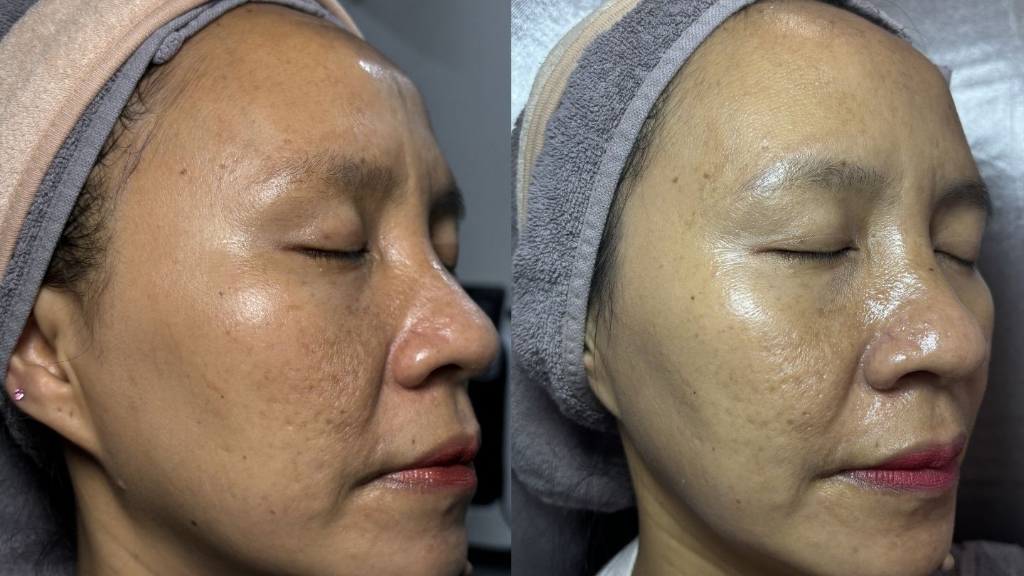 Flek hitam & melasma susah hilang? Kenali penyebab dan temukan treatment klinis terbaik di Prossi Clinic.