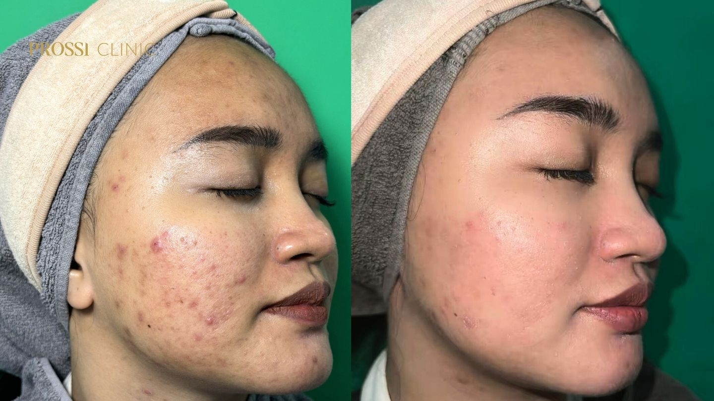 Perjalanan Pasien Jerawat Prossi Clinic: Dari Jerawat Meradang hingga Kulit Lebih Sehat: