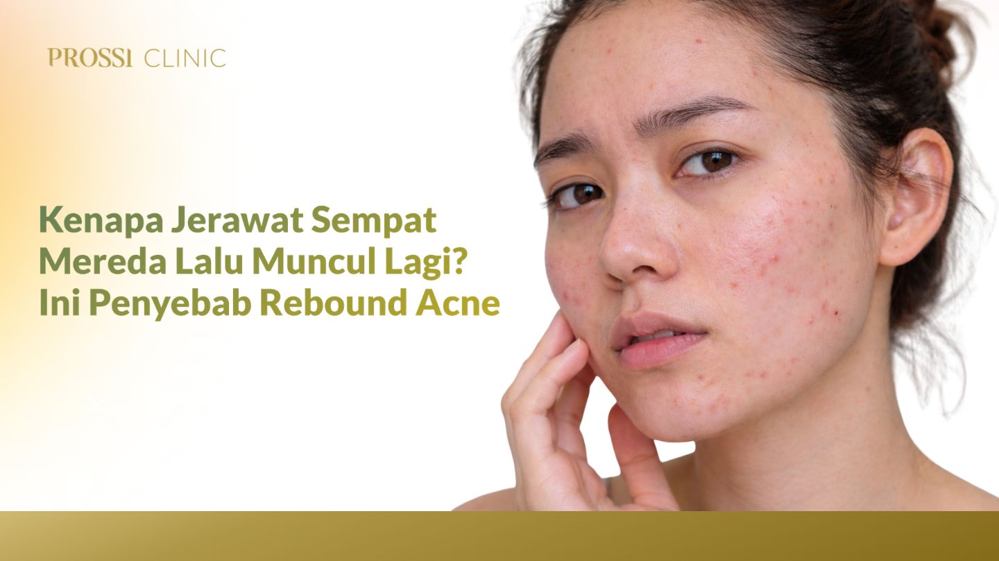 Kenapa Jerawat Sempat Mereda Lalu Muncul Lagi? Ini Penyebab Rebound Acne 