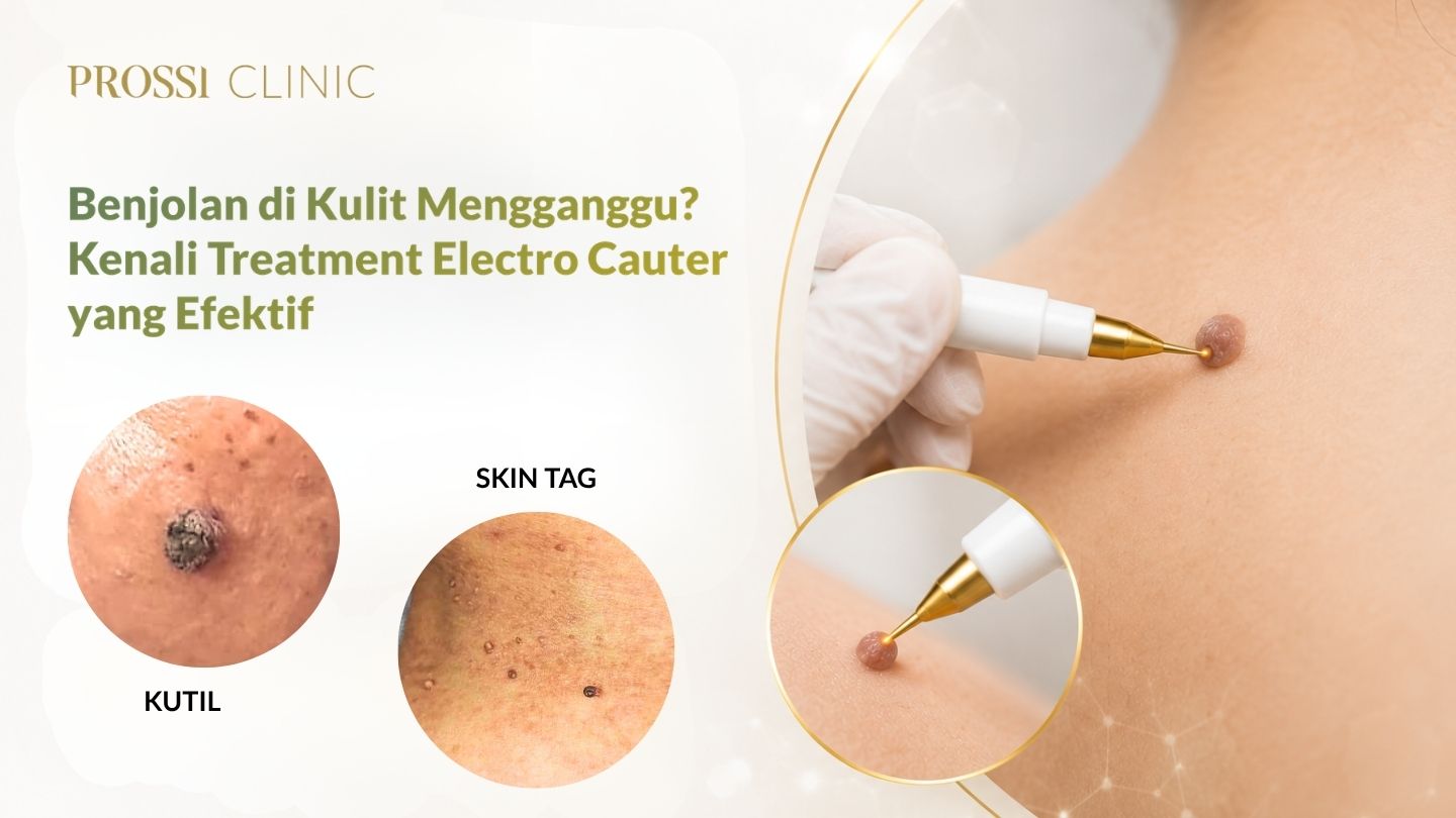 Benjolan di Kulit Mengganggu? Kenali Treatment Electro Cauter yang Efektif