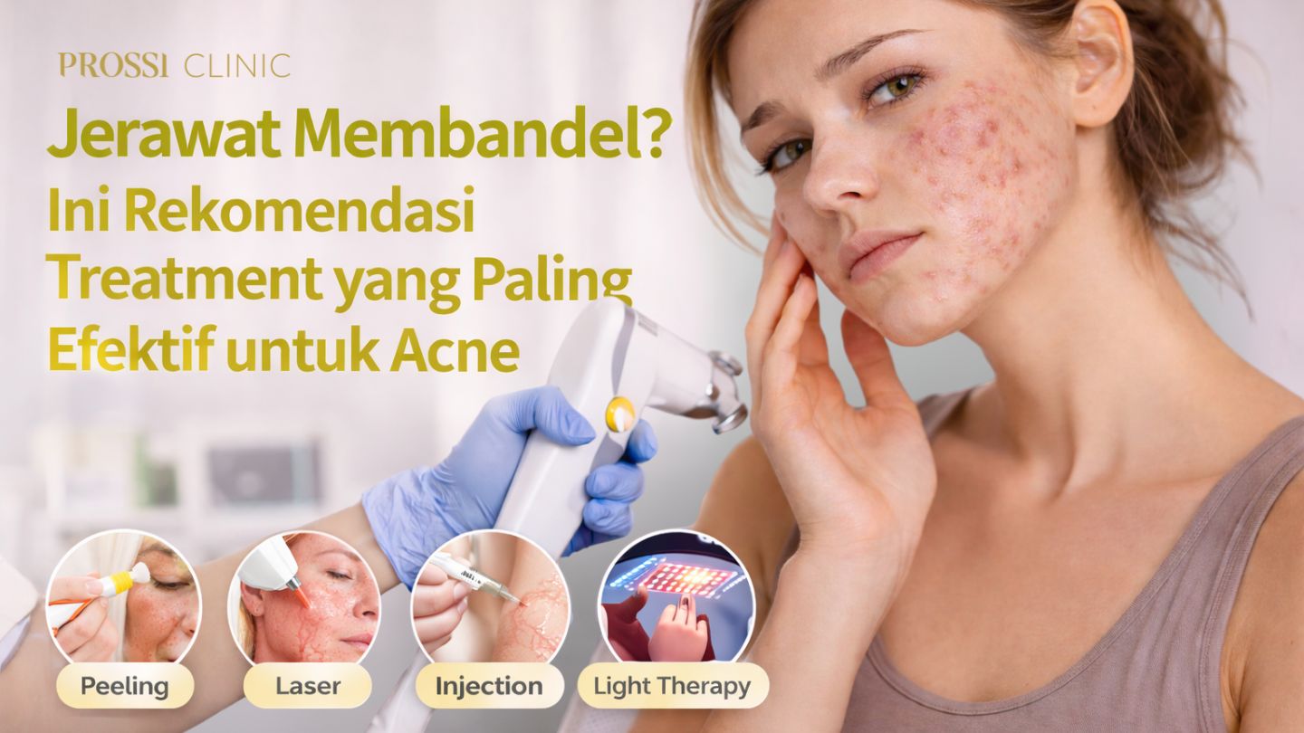 Jerawat Membandel? Ini Rekomendasi Treatment yang Paling Efektif untuk Acne 
