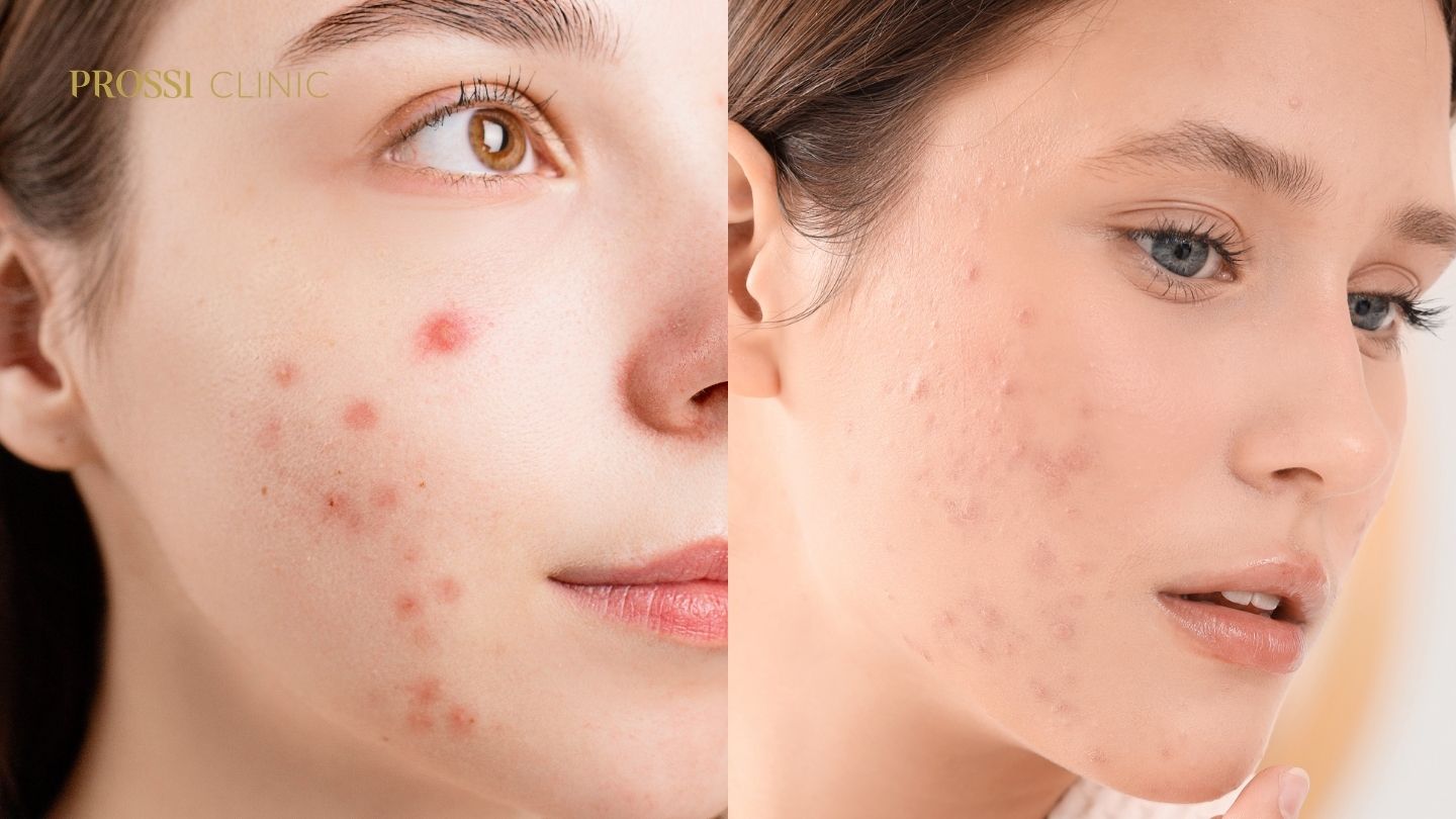Perbedaan Jerawat Aktif dan Bekas Jerawat (PIH, PIE, Acne Scar)