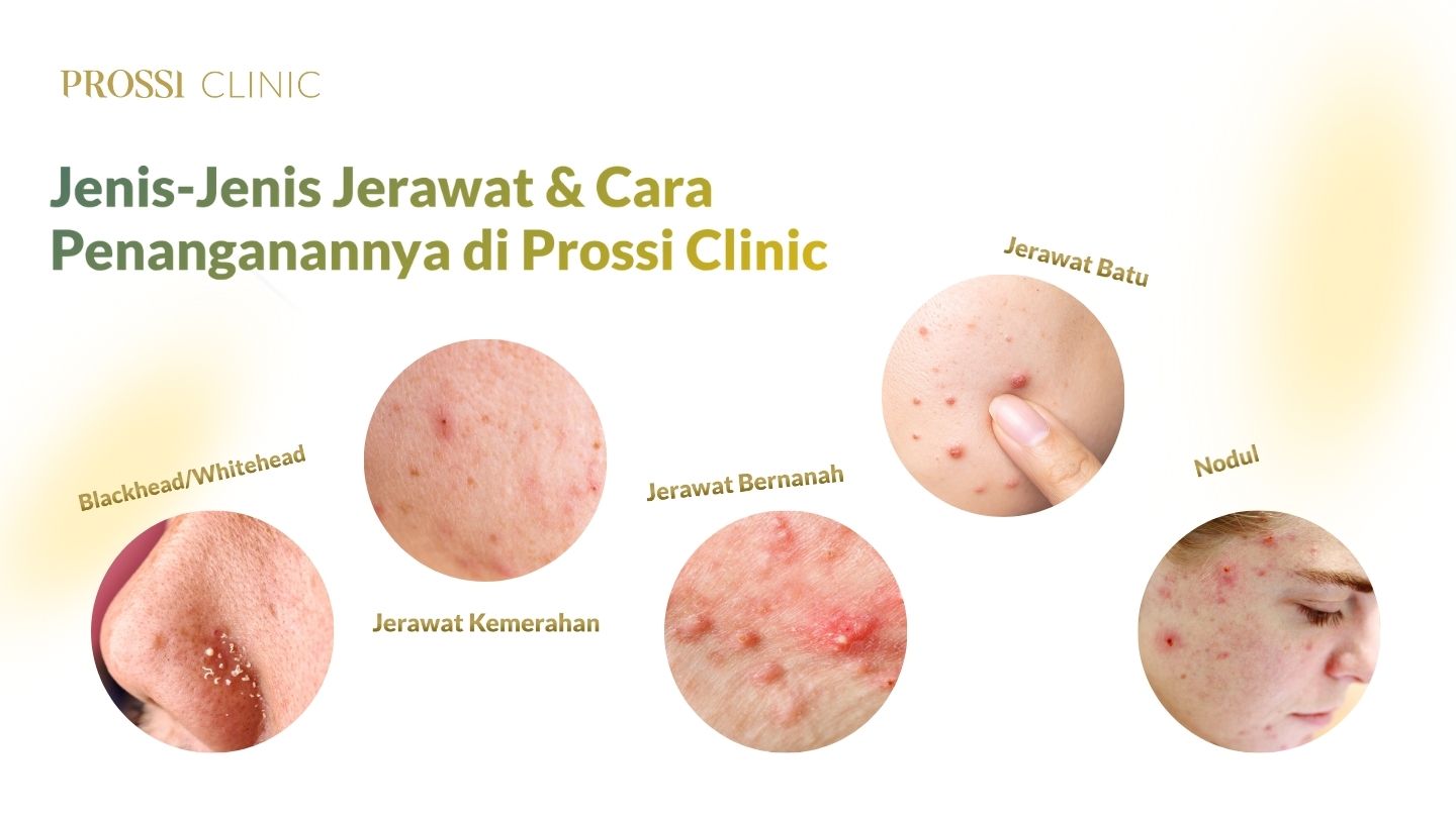 Mengenal Jenis-Jenis Jerawat dan Cara Penanganannya di Prossi Clinic