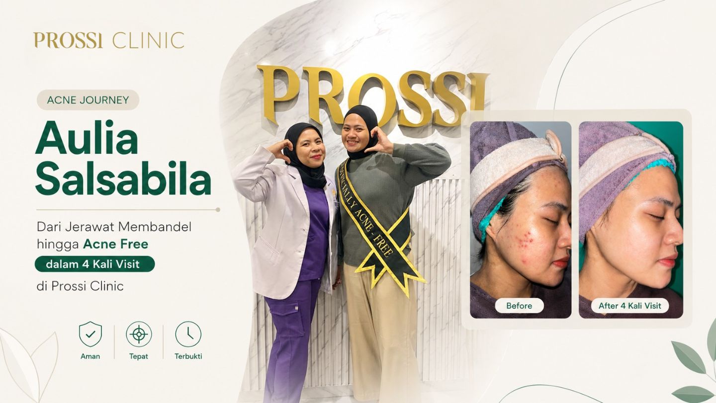Acne Journey Aulia Salsabila: Dari Jerawat Membandel hingga Acne Free dalam 4 Kali Visit di Prossi Clinic 