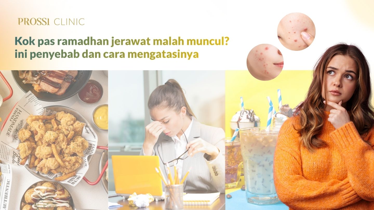 Kenapa Jerawat Muncul Saat Puasa Ramadhan? Ini Penyebab dan Cara Mengatasinya