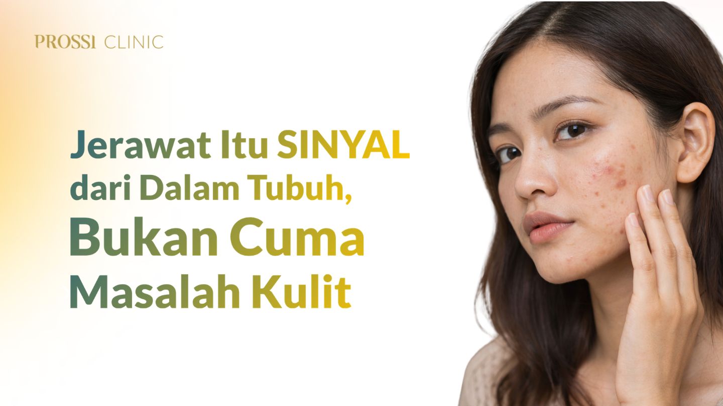 Jerawat Itu Sinyal dari Dalam Tubuh, Bukan Cuma Masalah Kulit