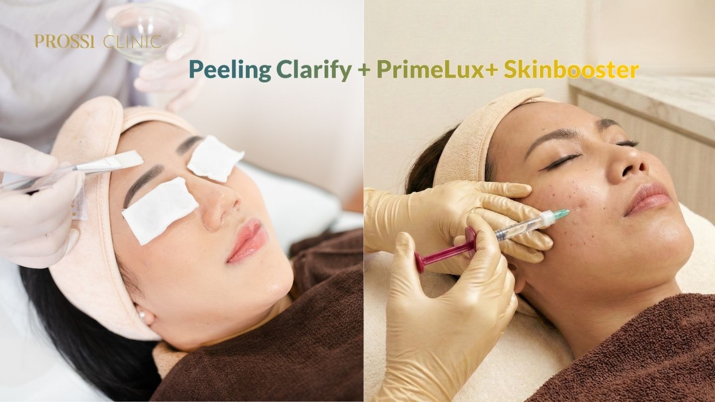 2 Treatment Kombinasi Paling Ampuh Atasi Jerawat: Peeling Clarify & PrimeLux+ Skinbooster